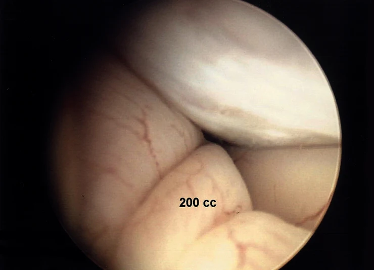 Separation of bowel loops with 200cc of Adept adhesion reduction solution. Litle separation is shown
